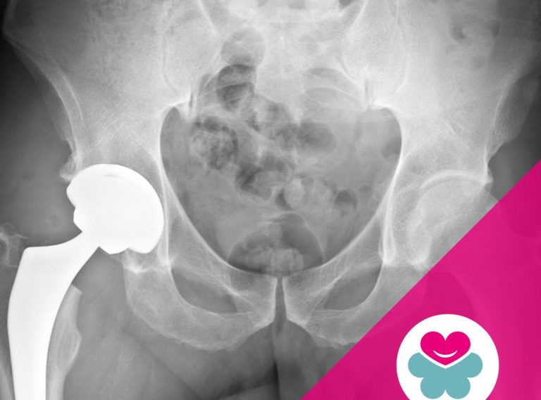 Coxartrosi anca sintomi