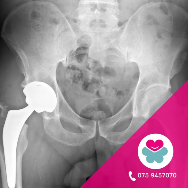 Coxartrosi anca sintomi