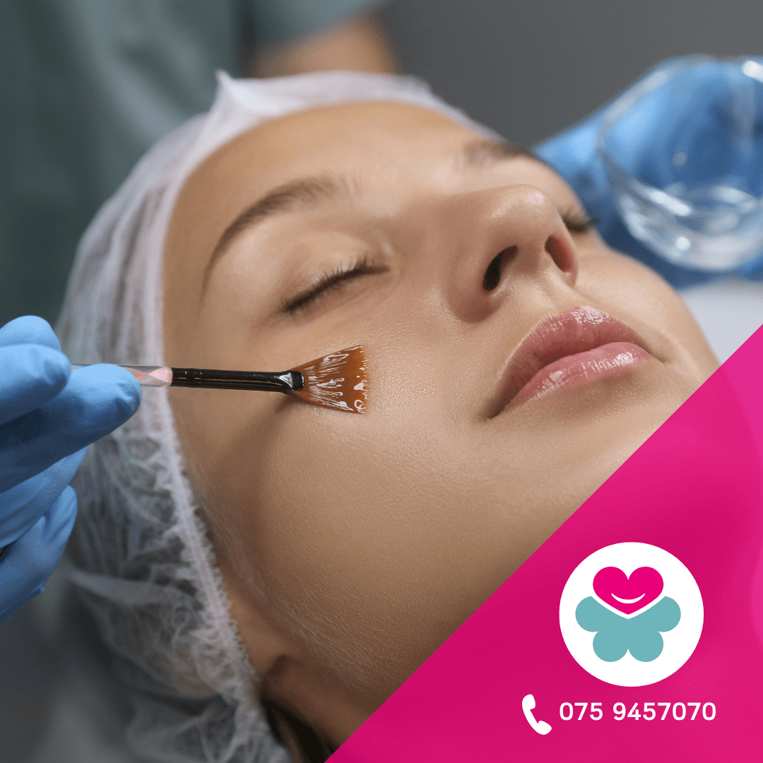 peeling viso